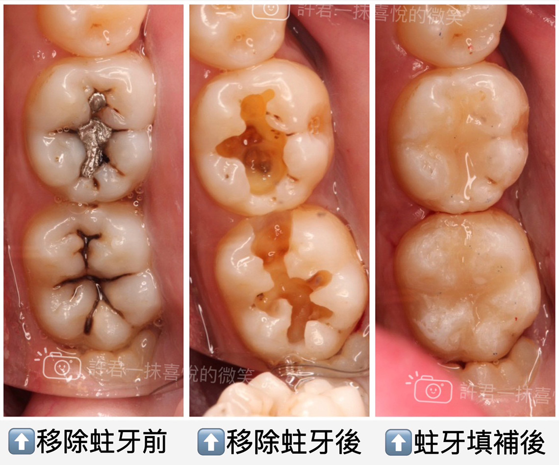 什麼?牙齒好像要斷了!?