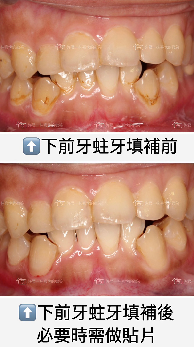 什麼?牙齒好像要斷了!?