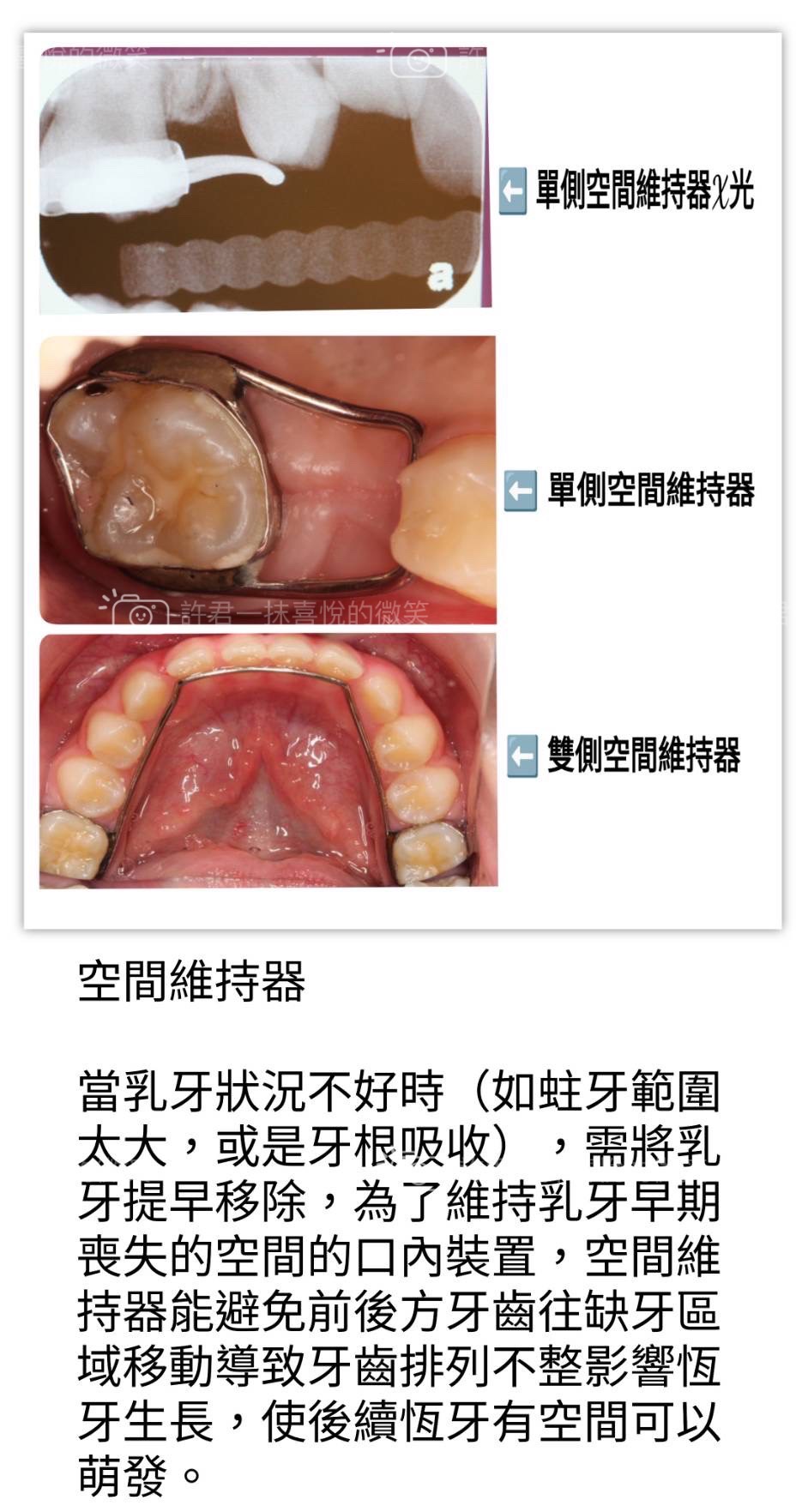第一大臼齒是小朋友長的第一顆恆牙,用最久也是最容易蛀牙的牙齒