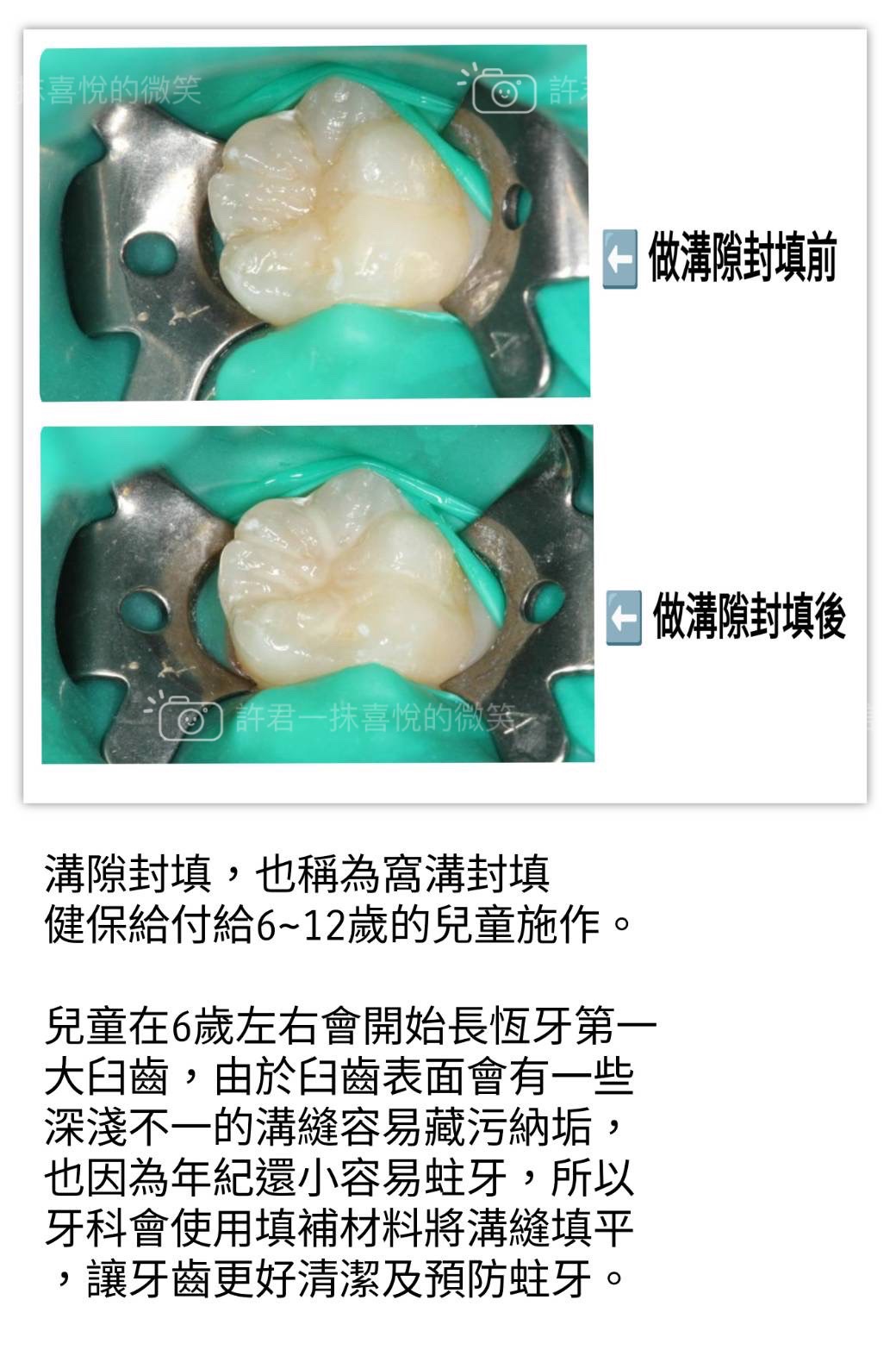 第一大臼齒是小朋友長的第一顆恆牙,用最久也是最容易蛀牙的牙齒