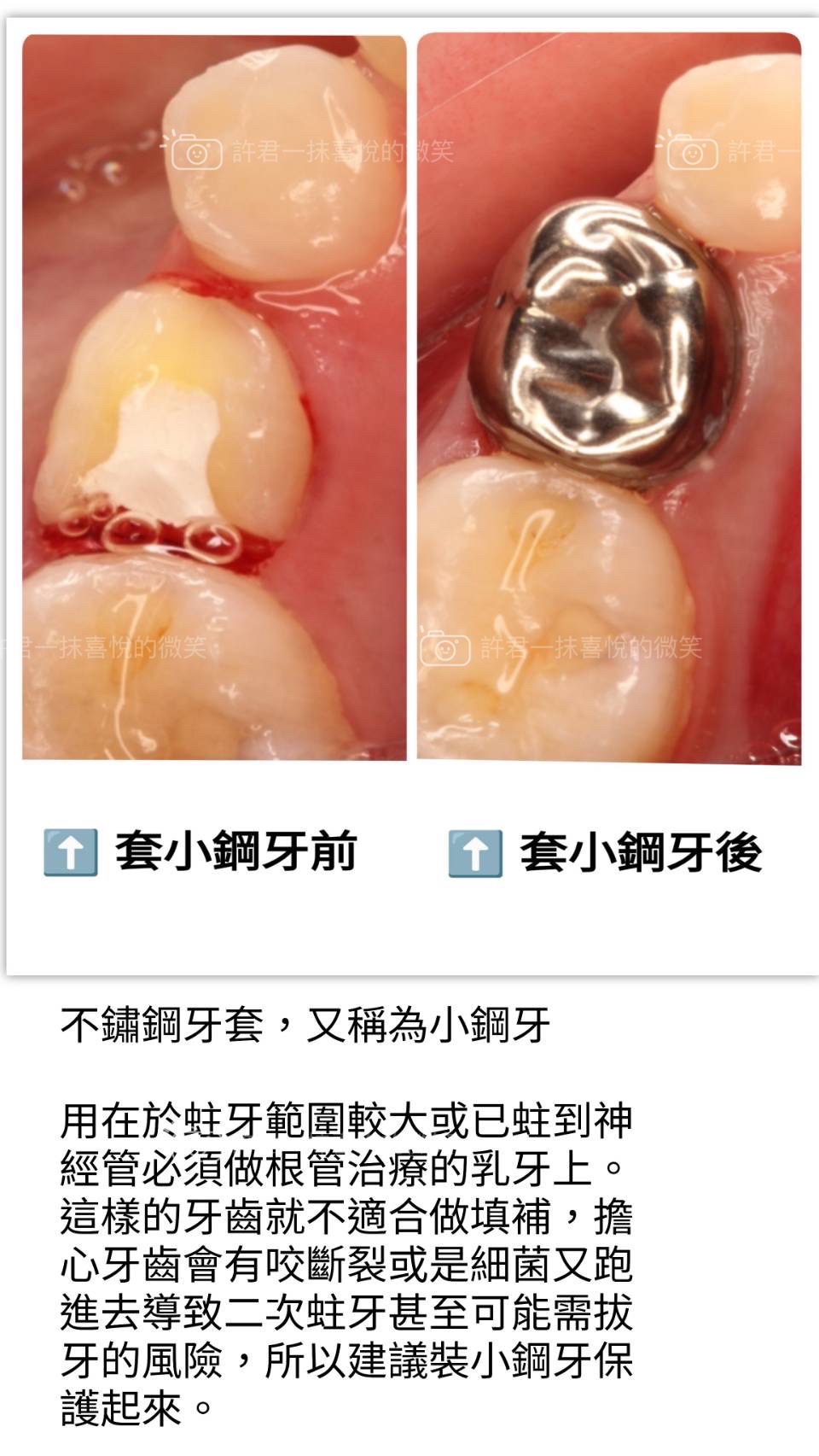 第一大臼齒是小朋友長的第一顆恆牙,用最久也是最容易蛀牙的牙齒