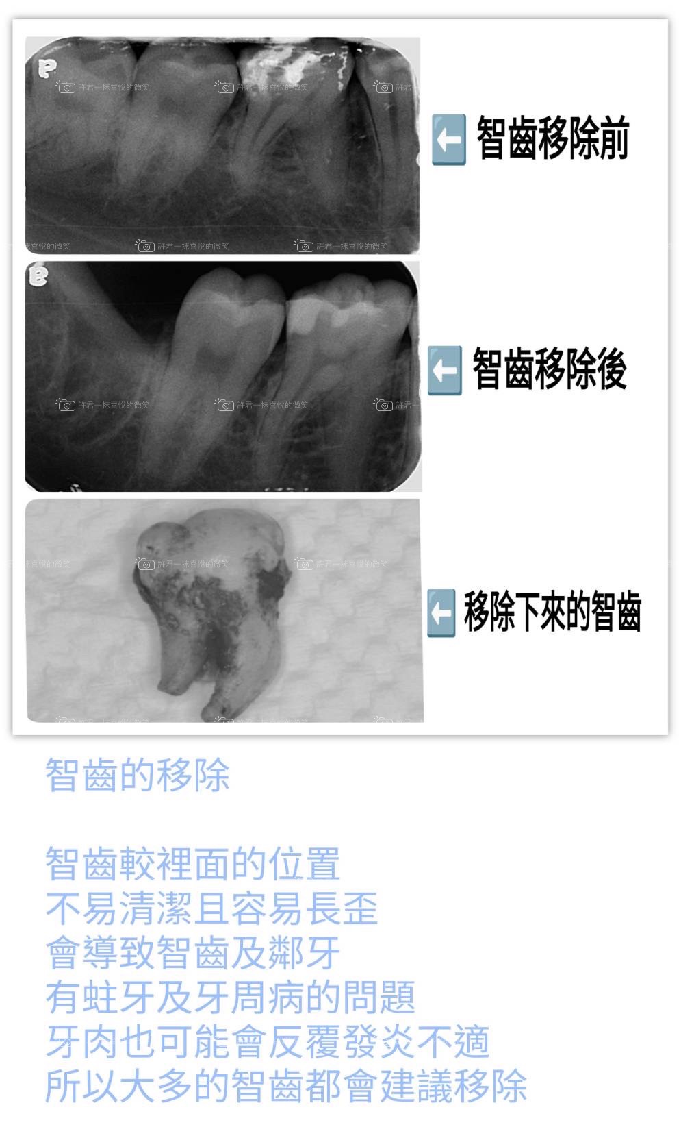 很少機會牙裂能夠被X光拍出來~!!!