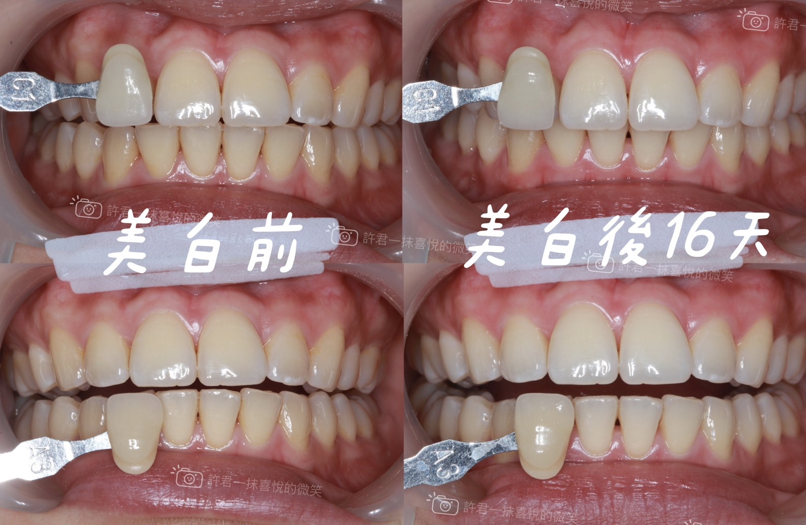 居家美白案例