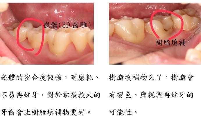 黃金嵌體做了10年表現仍然很良好❤️🔥