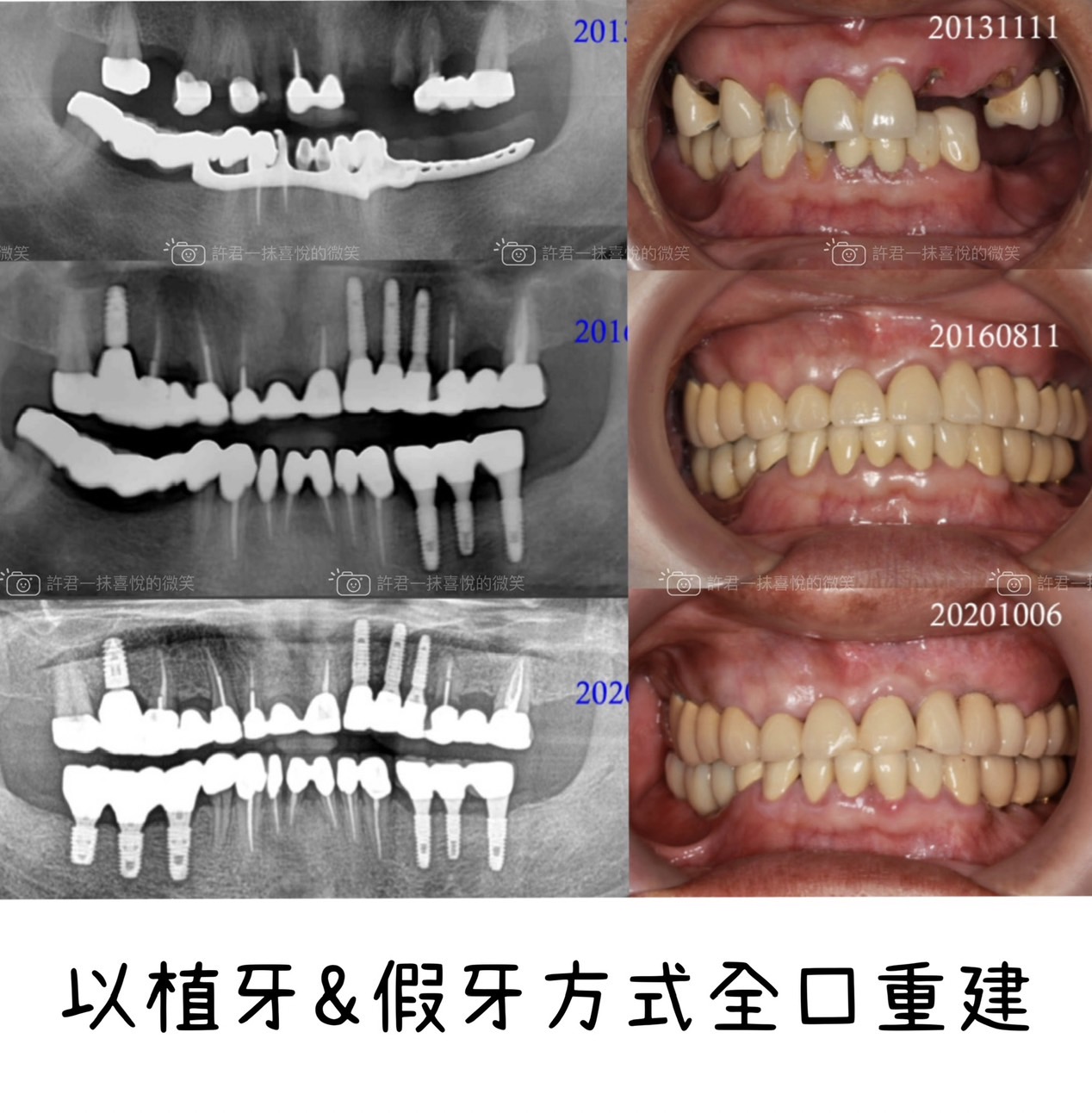 害怕手術,選擇做活動假牙