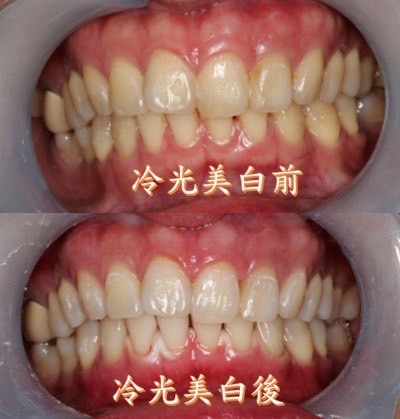 總是希望牙齒完美無瑕