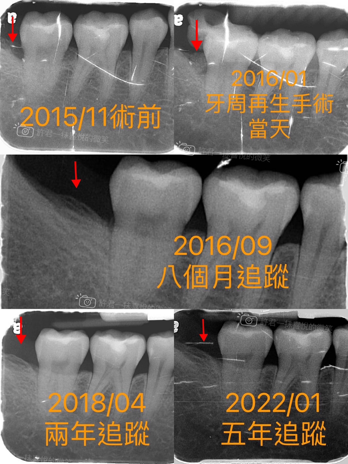第二階段治療(牙周再生手術)