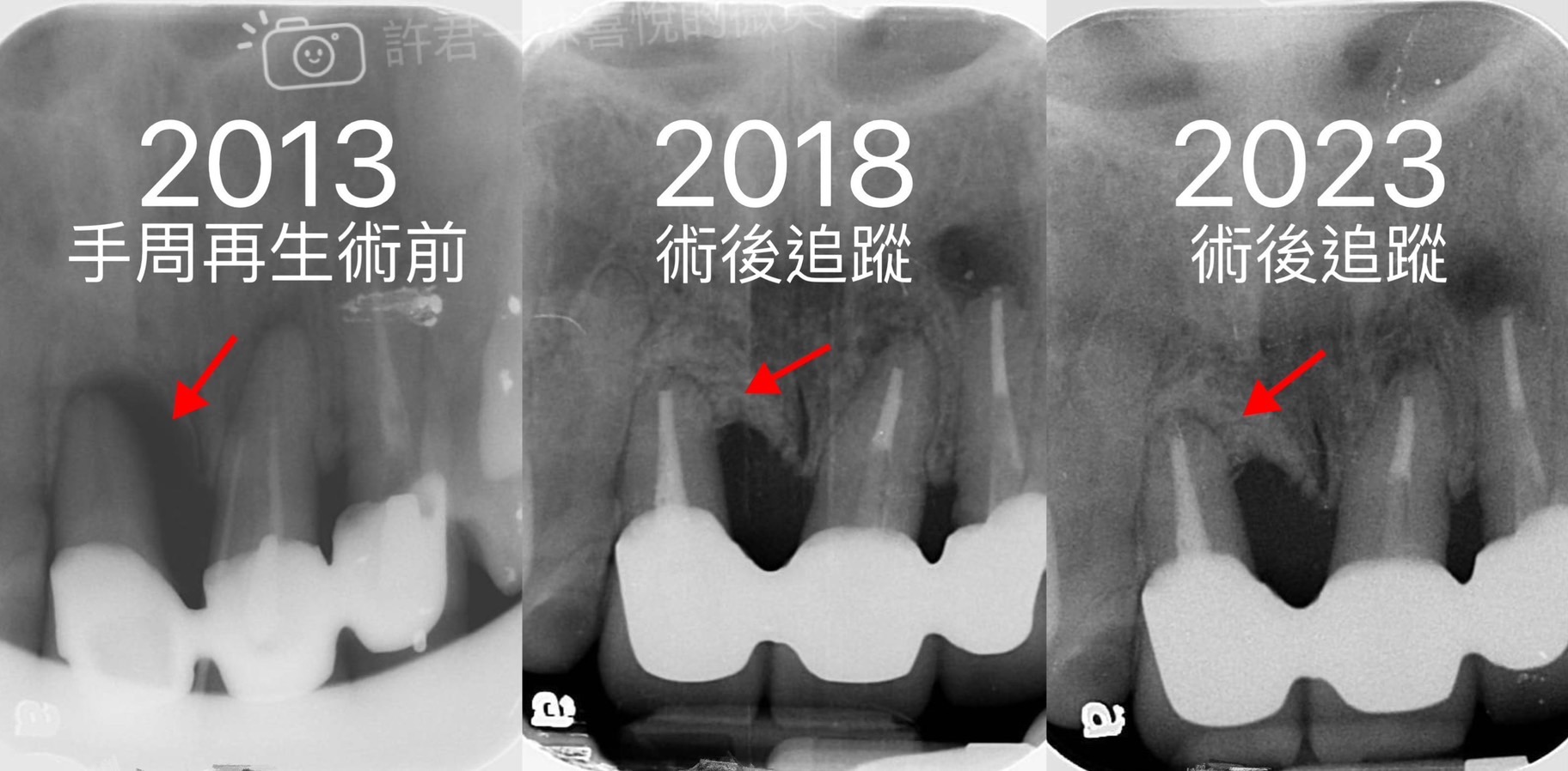 第二階段治療(牙周再生手術)