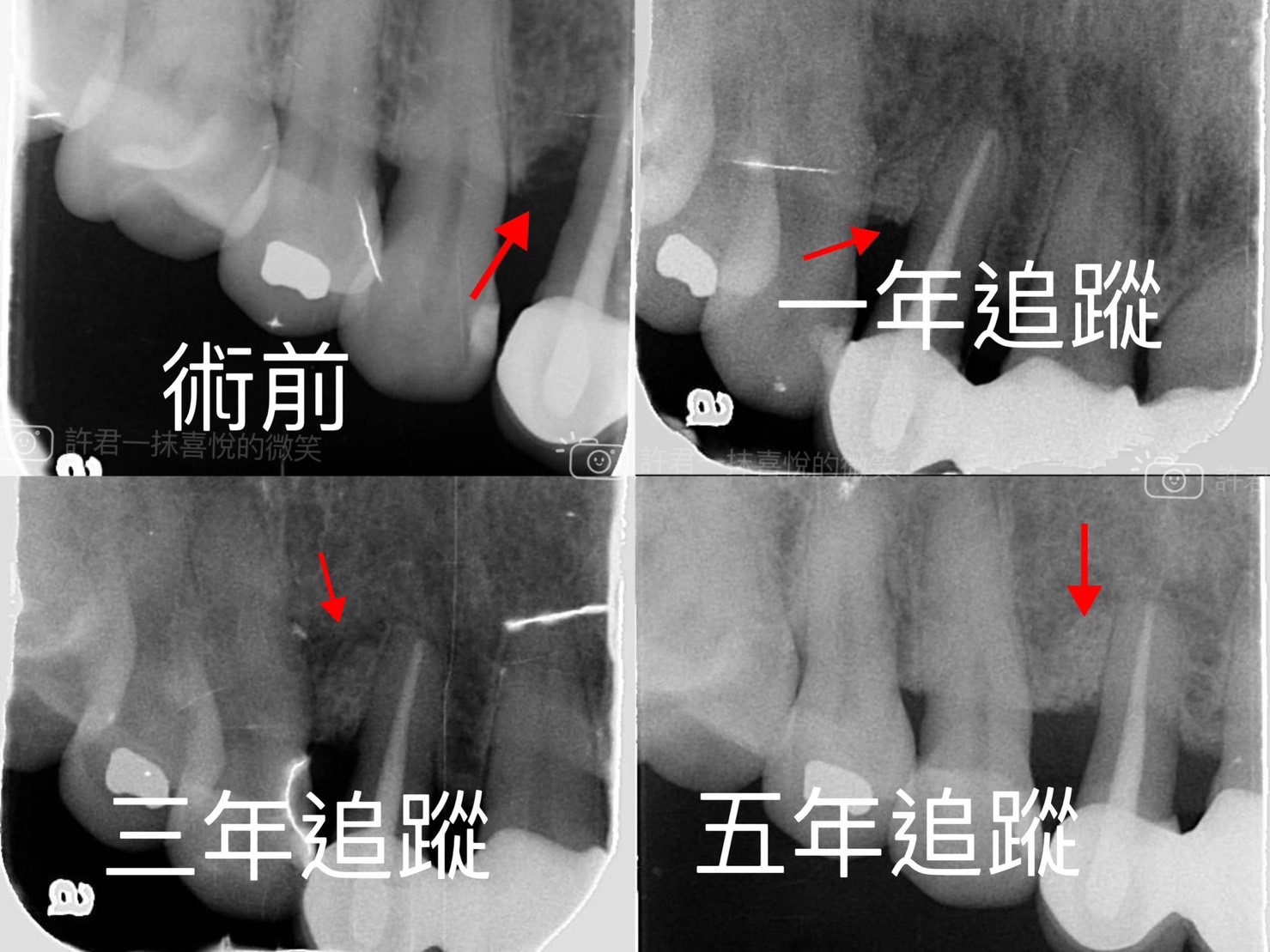 第二階段治療(牙周再生手術)
