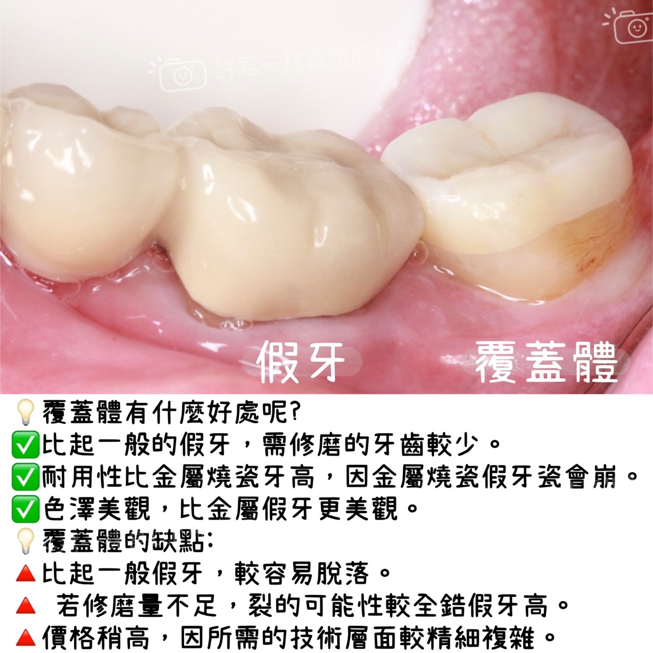 覆蓋體案例
