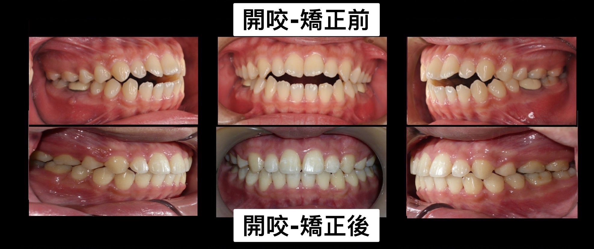 前牙咬不到好困擾