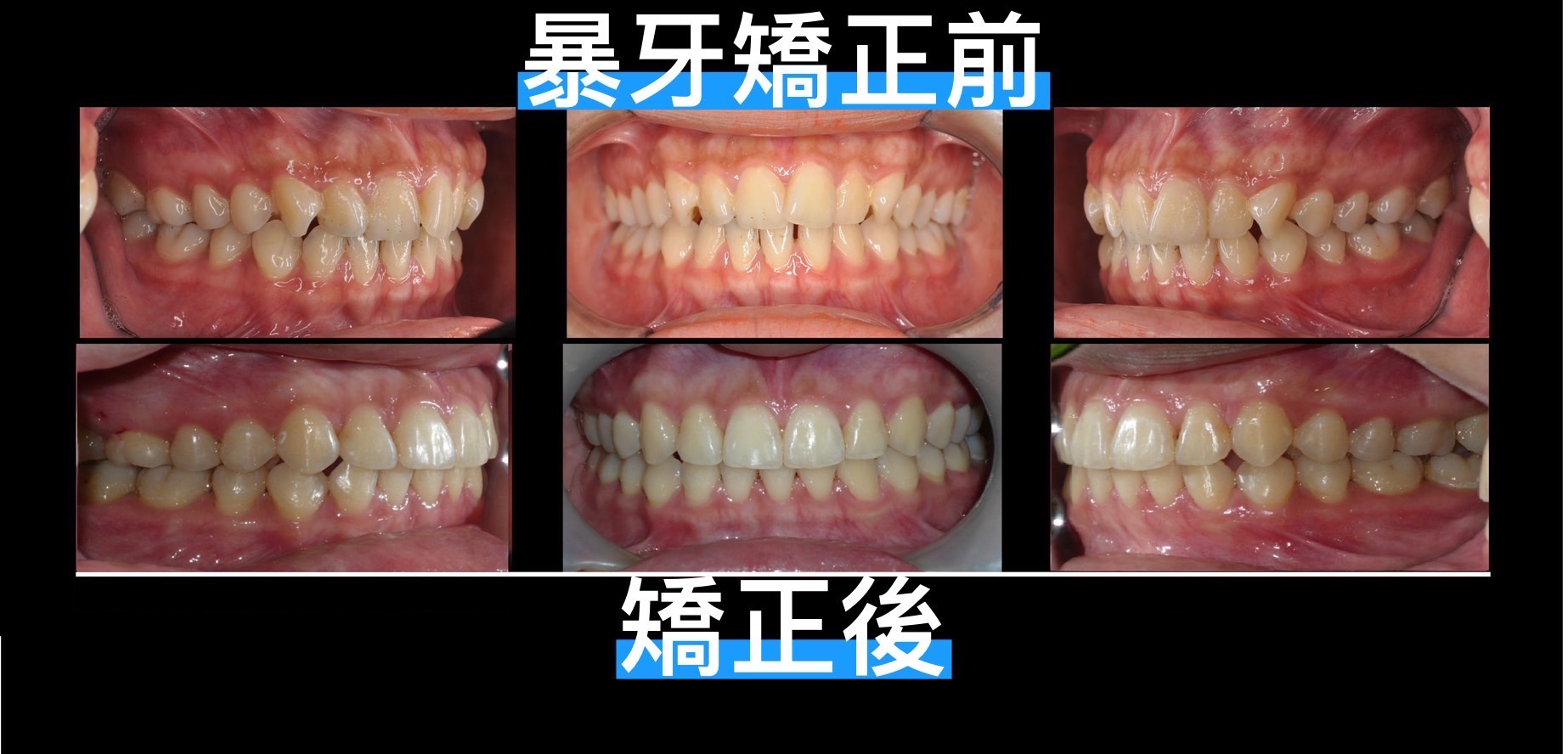 前牙咬不到好困擾