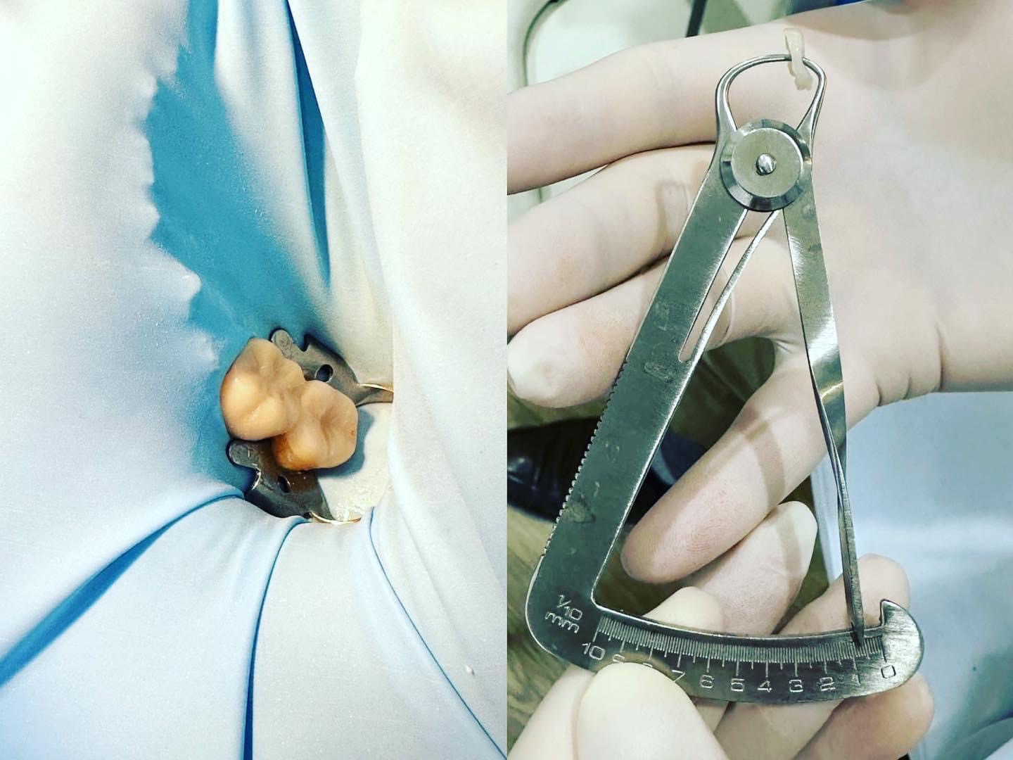 咬裂的牙齒可以怎麼辦?