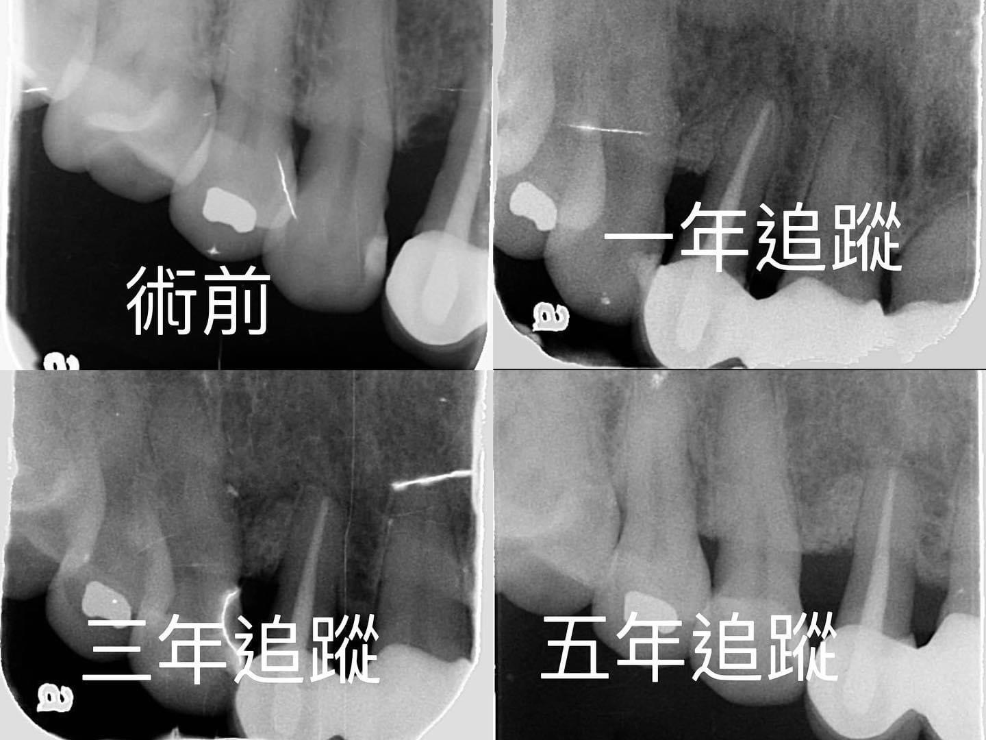 第二階段治療(牙周再生手術)
