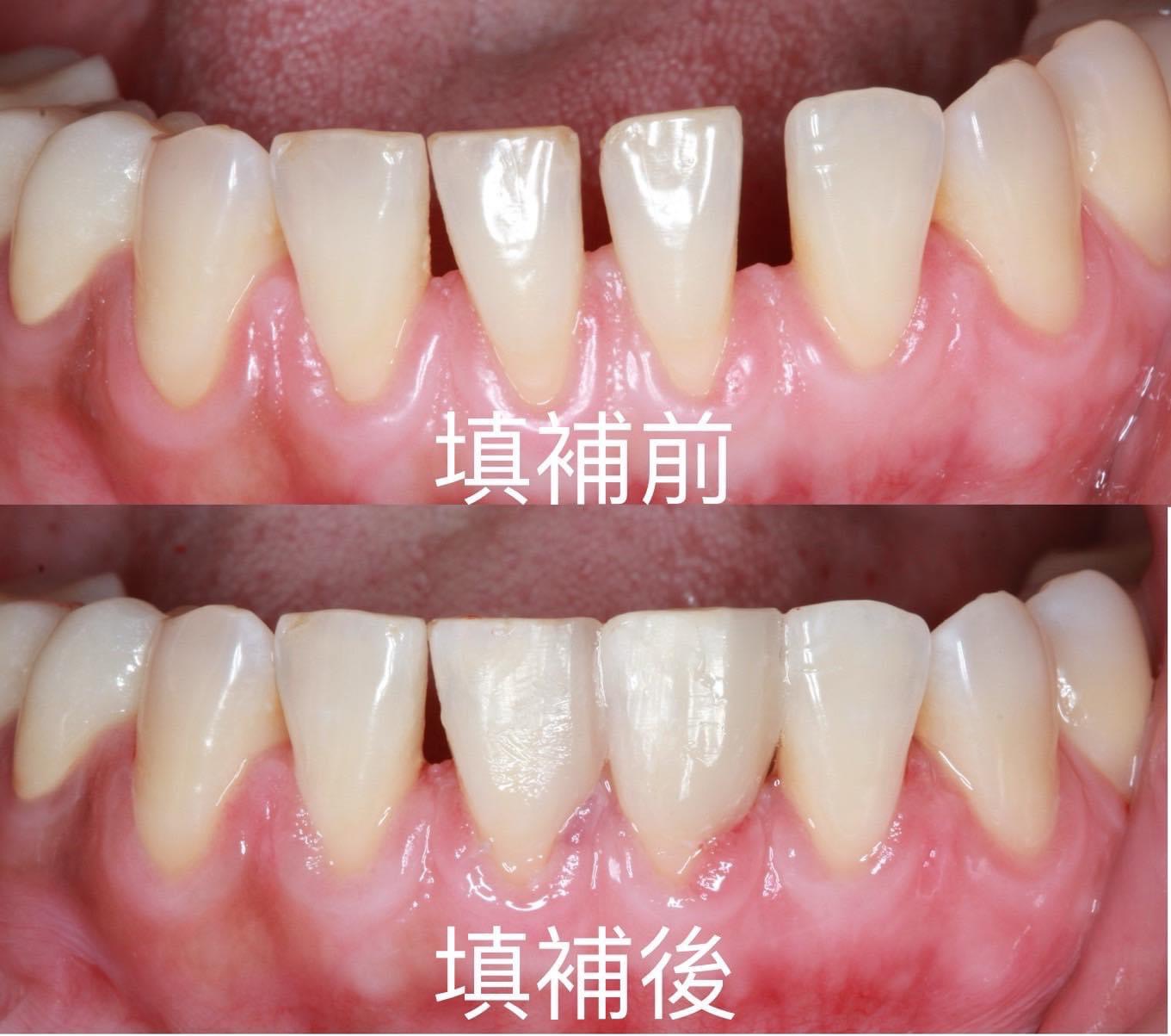 門縫填補案例