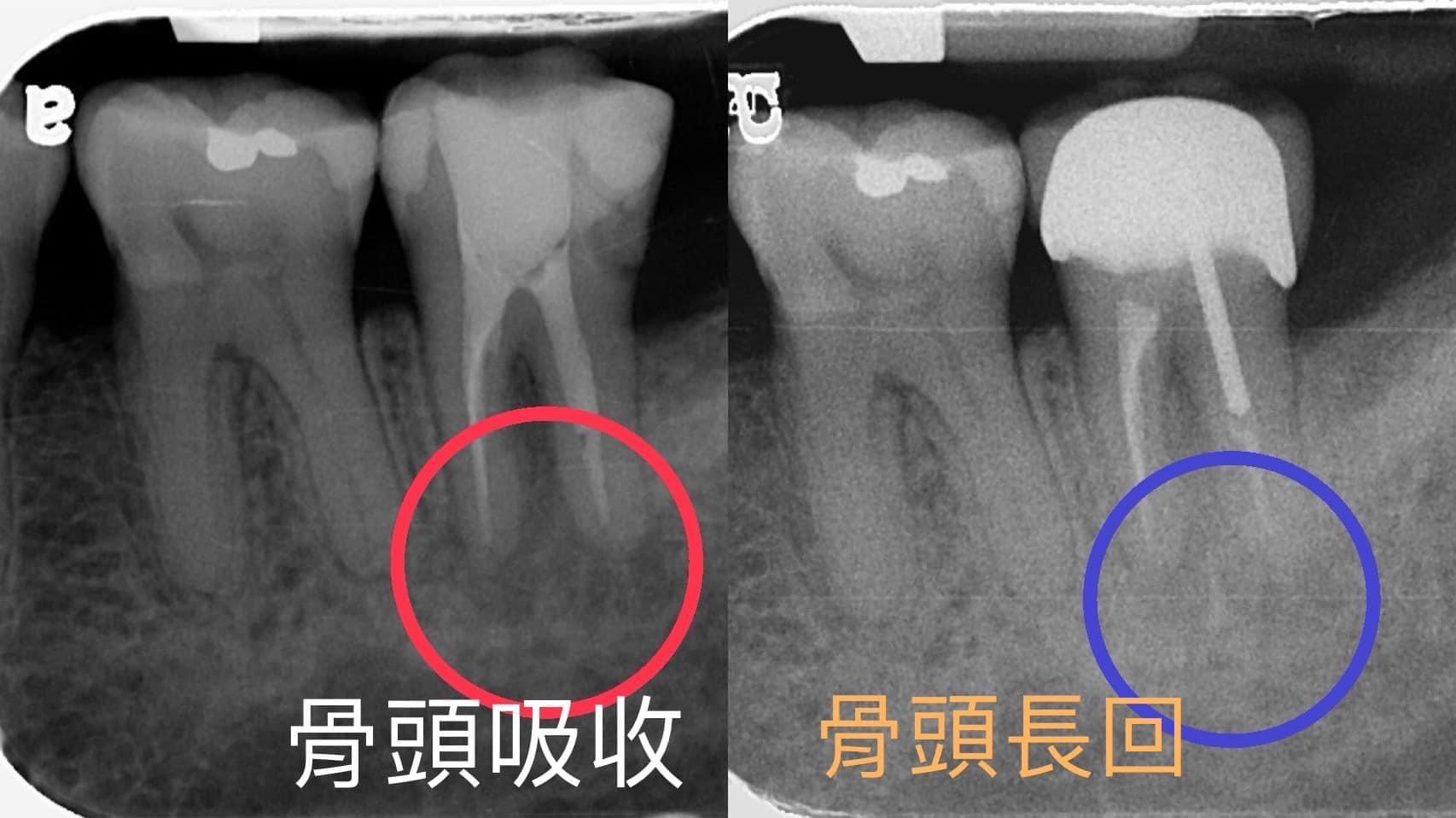神經壞死引起的牙周破壞