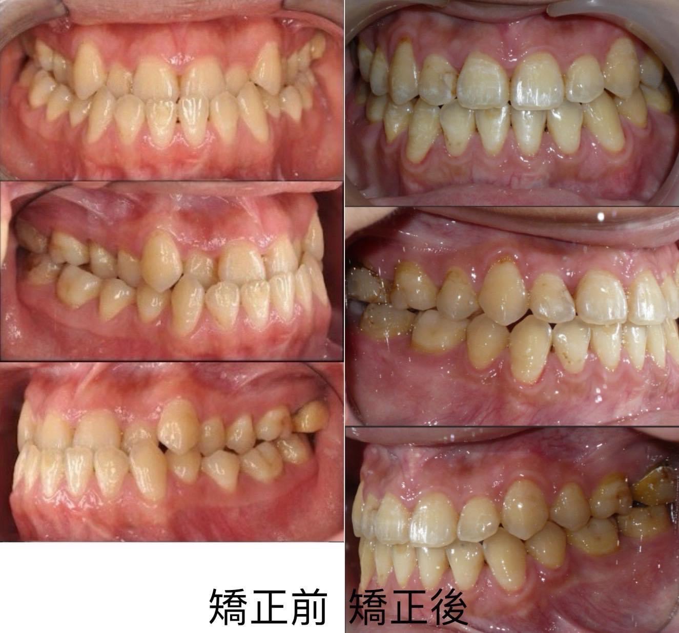 前牙咬不到好困擾