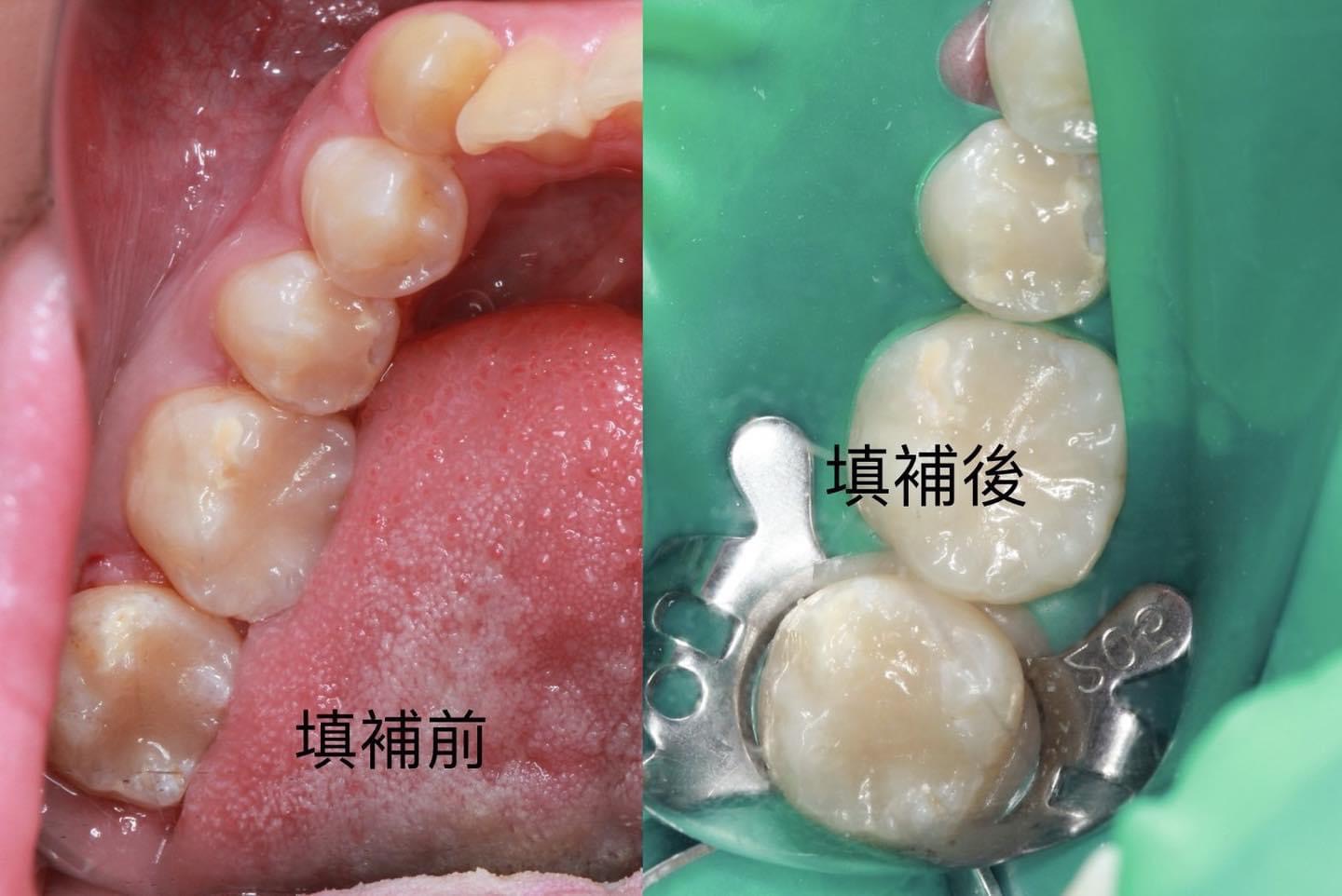什麼?牙齒好像要斷了!?