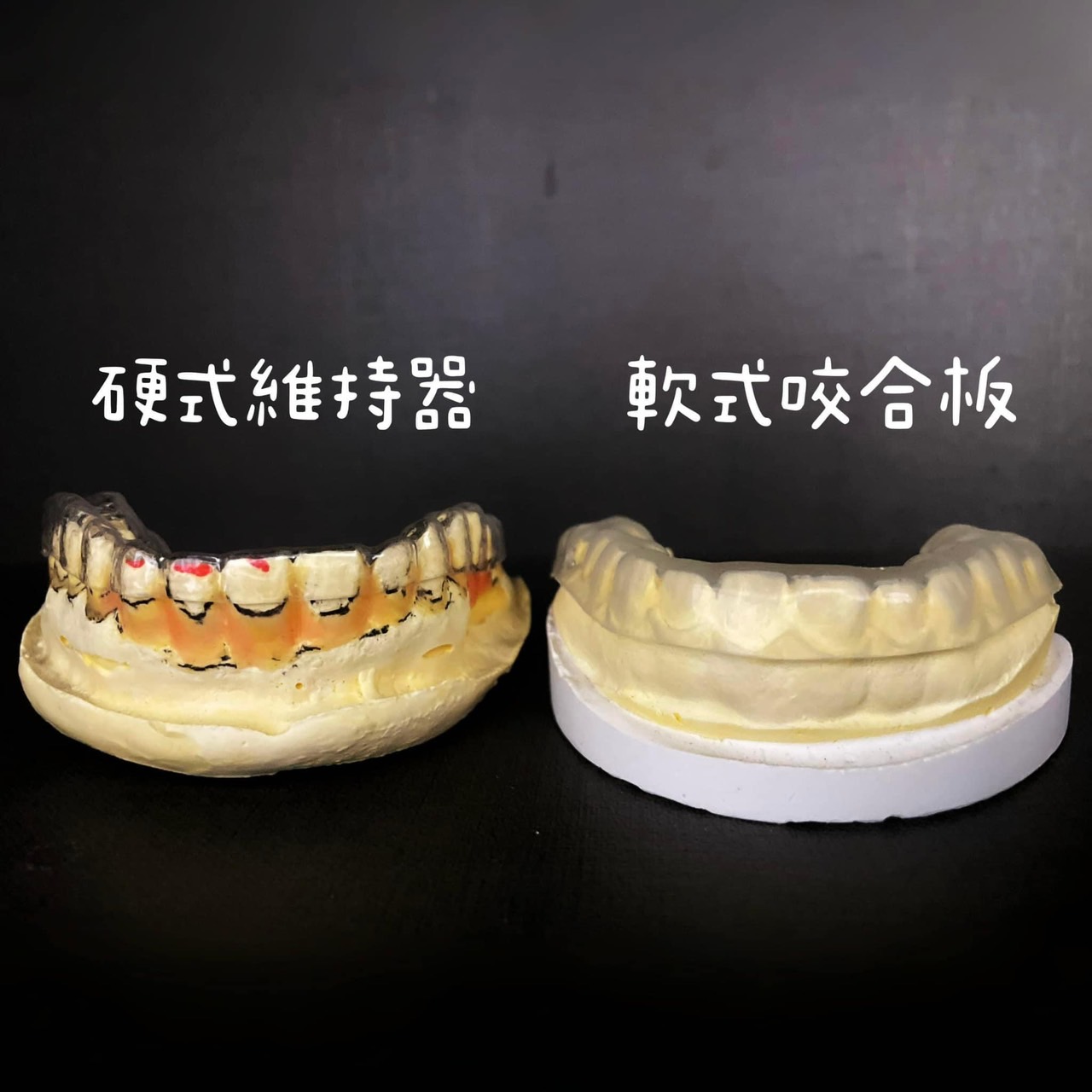 咬合板案例