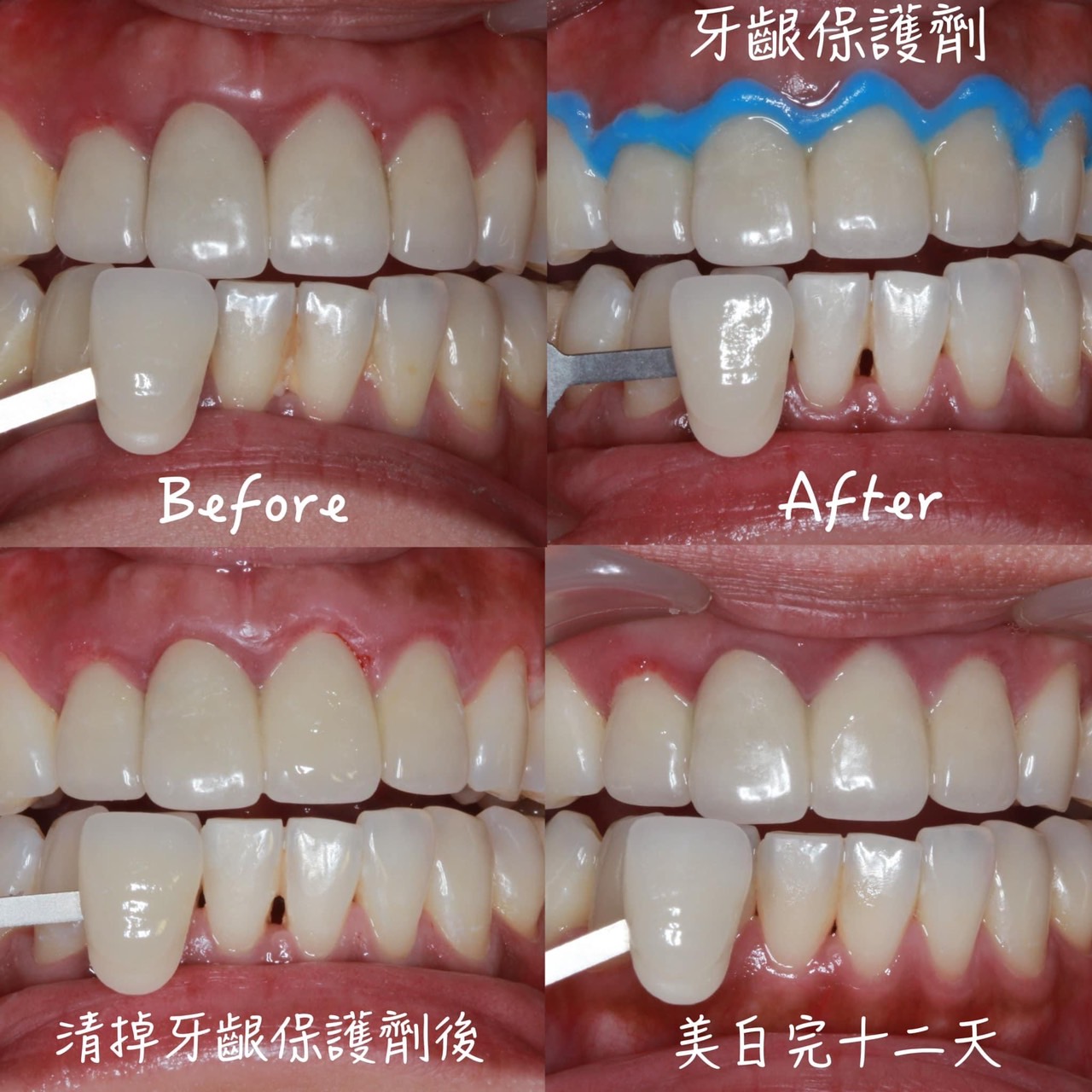 總是希望牙齒完美無瑕