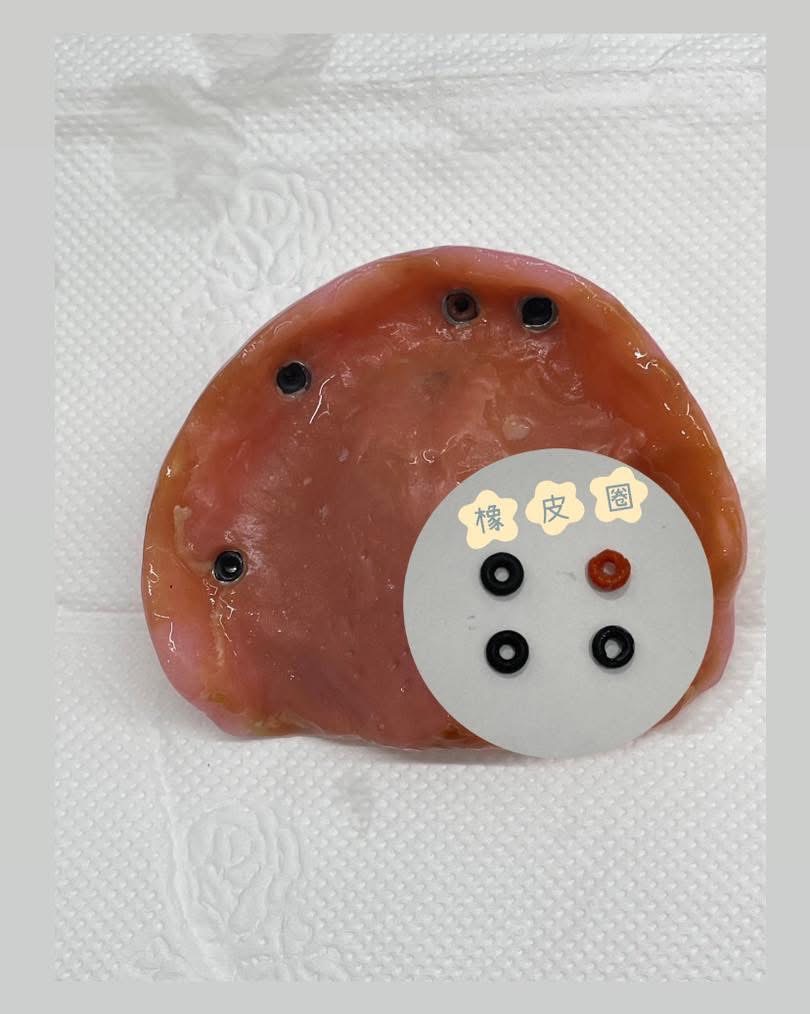 別以為只要完成活動假牙就萬事OK囉!