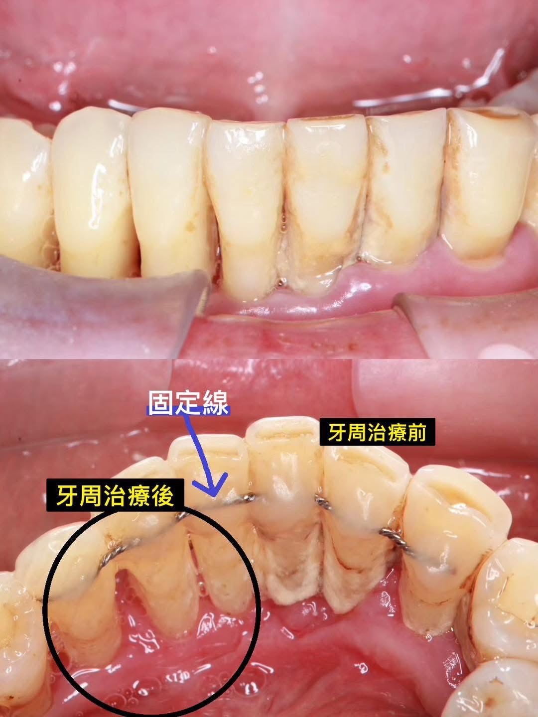 牙周病的恐怖...