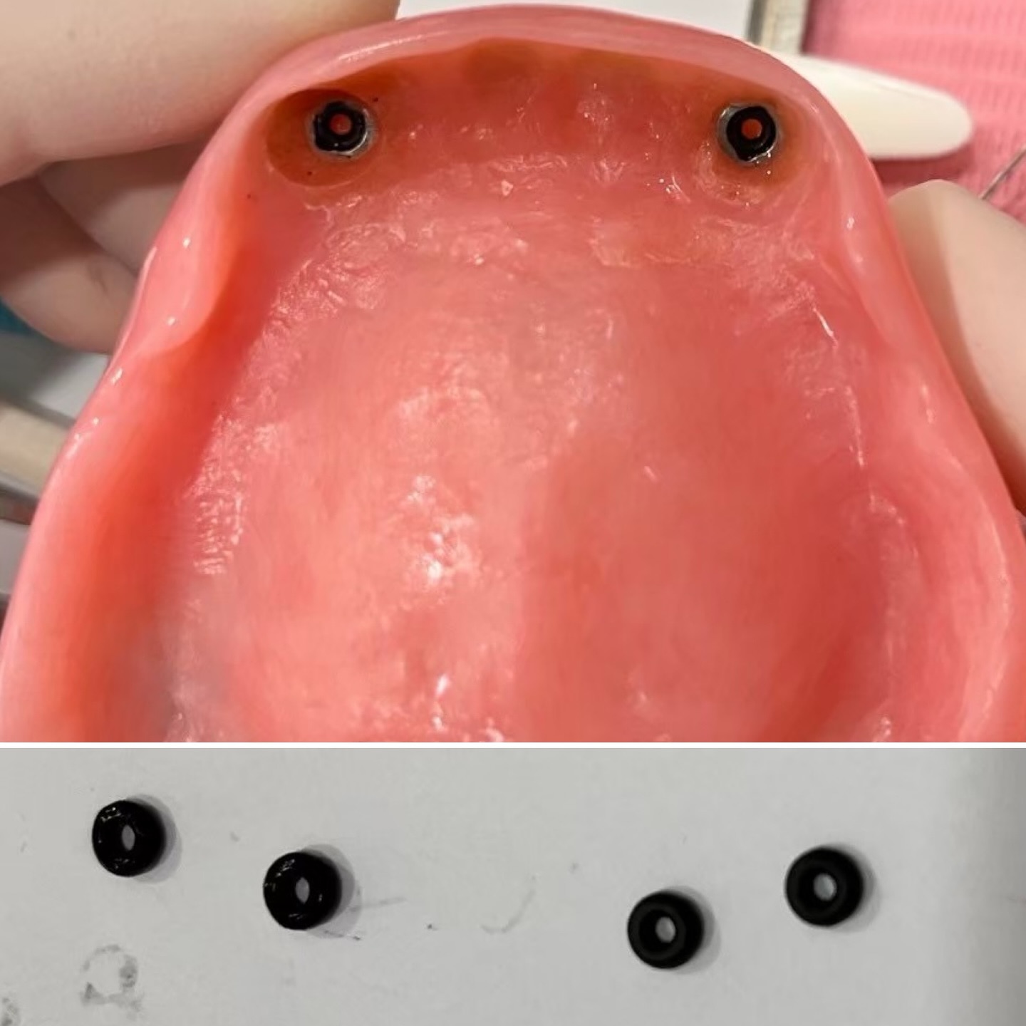 製作活動假牙方式百百種
