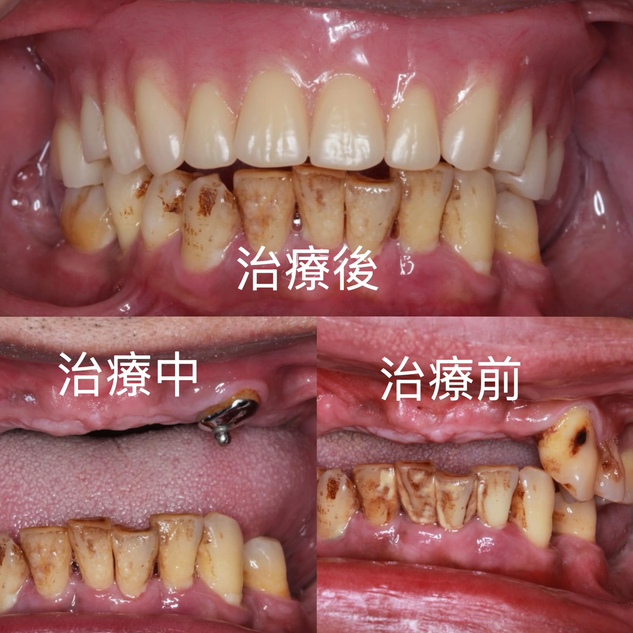 害怕手術,選擇做活動假牙