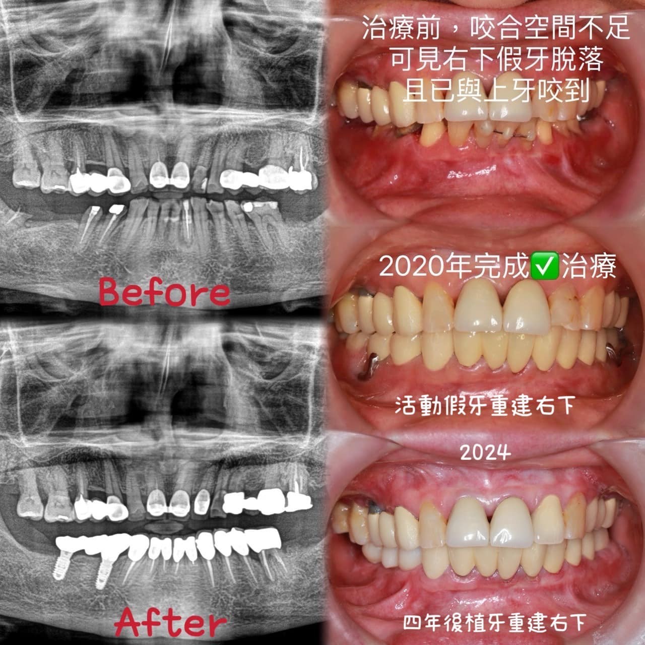 一次完成兩種術式解決不同問題,穩定療效,也能降低不適感