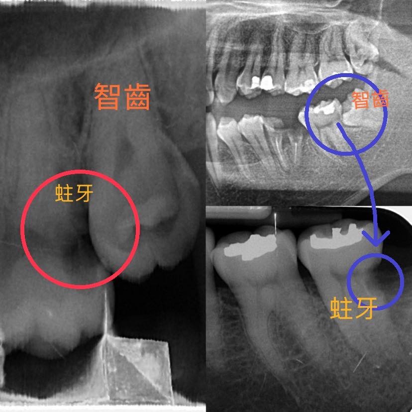 牙周病的恐怖...