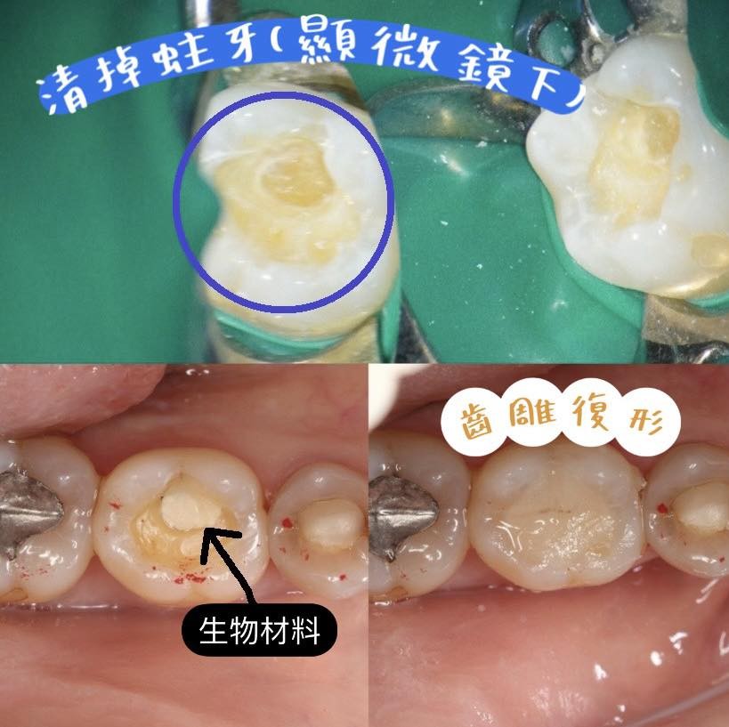 牙齒斷掉怎麼辦?