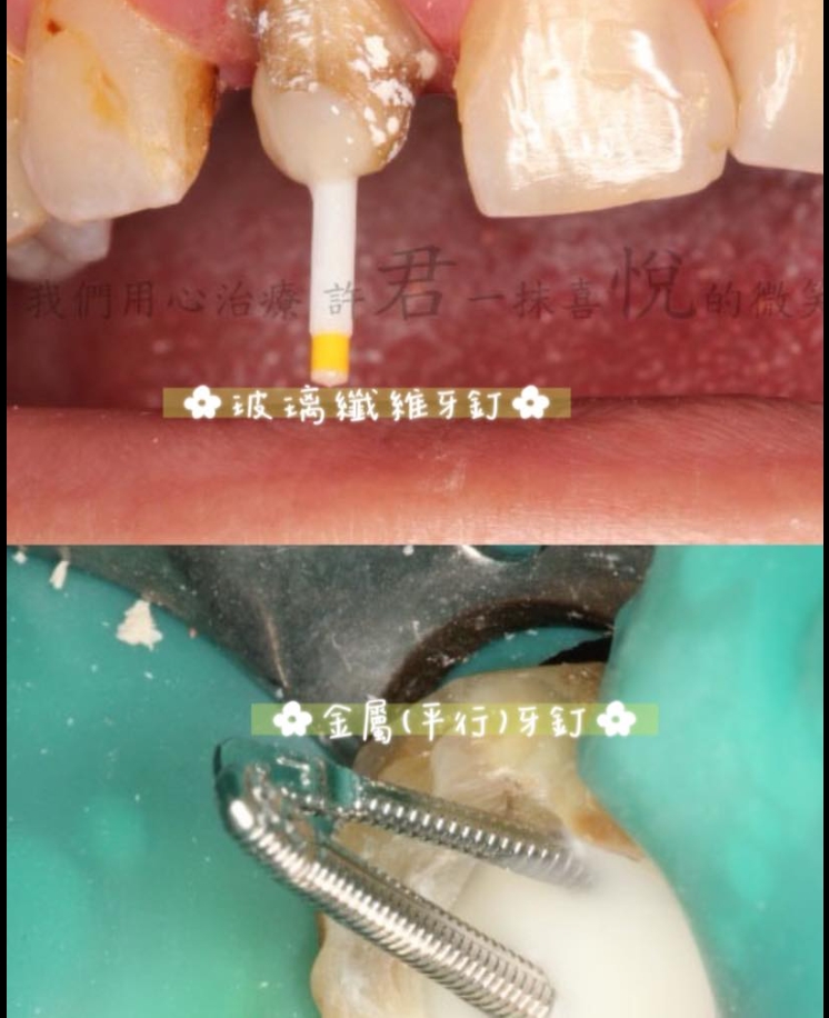 不一樣的假牙設計