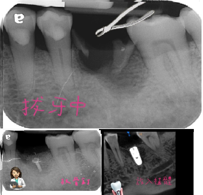 齒槽骨保存術