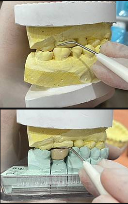 你有塞食物的困擾嗎