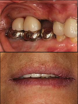 好燒腦~缺牙要做好做滿