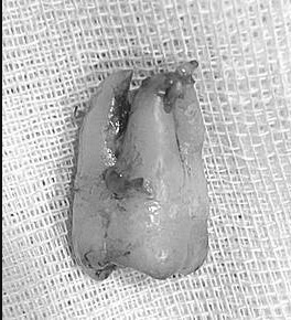 智齒牙根彎曲怎麼拔