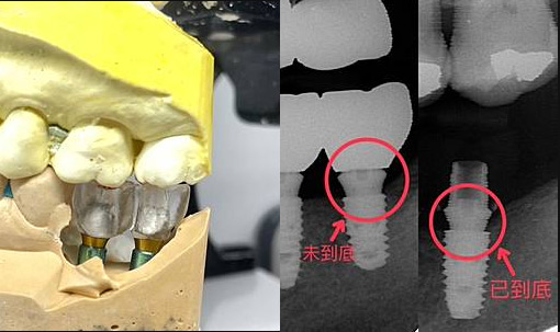 有聽說過透明牙冠嗎