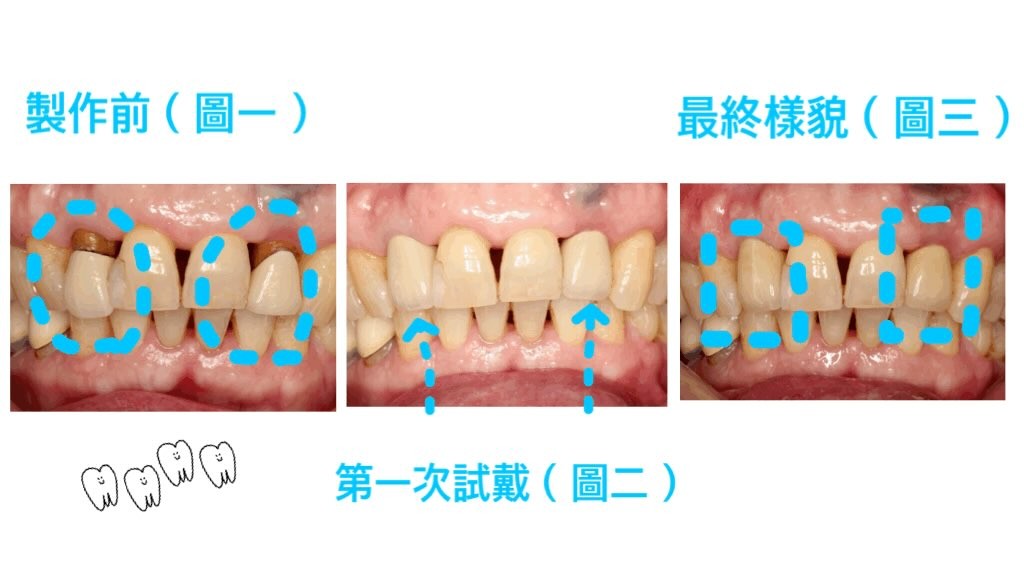 假牙美觀因人而異 你喜歡哪一種呢?