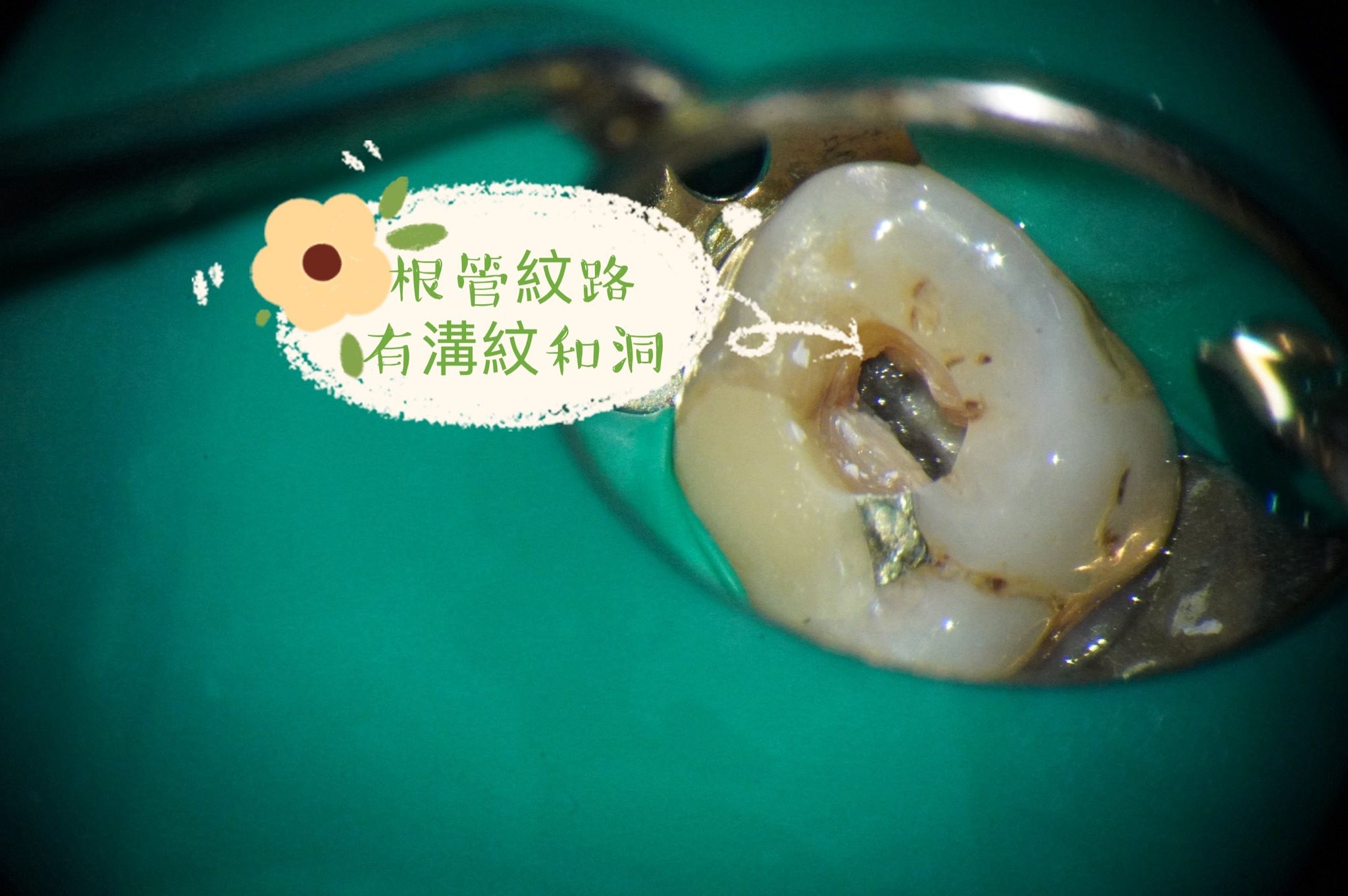蛀牙深只有抽神經一條路嗎?
