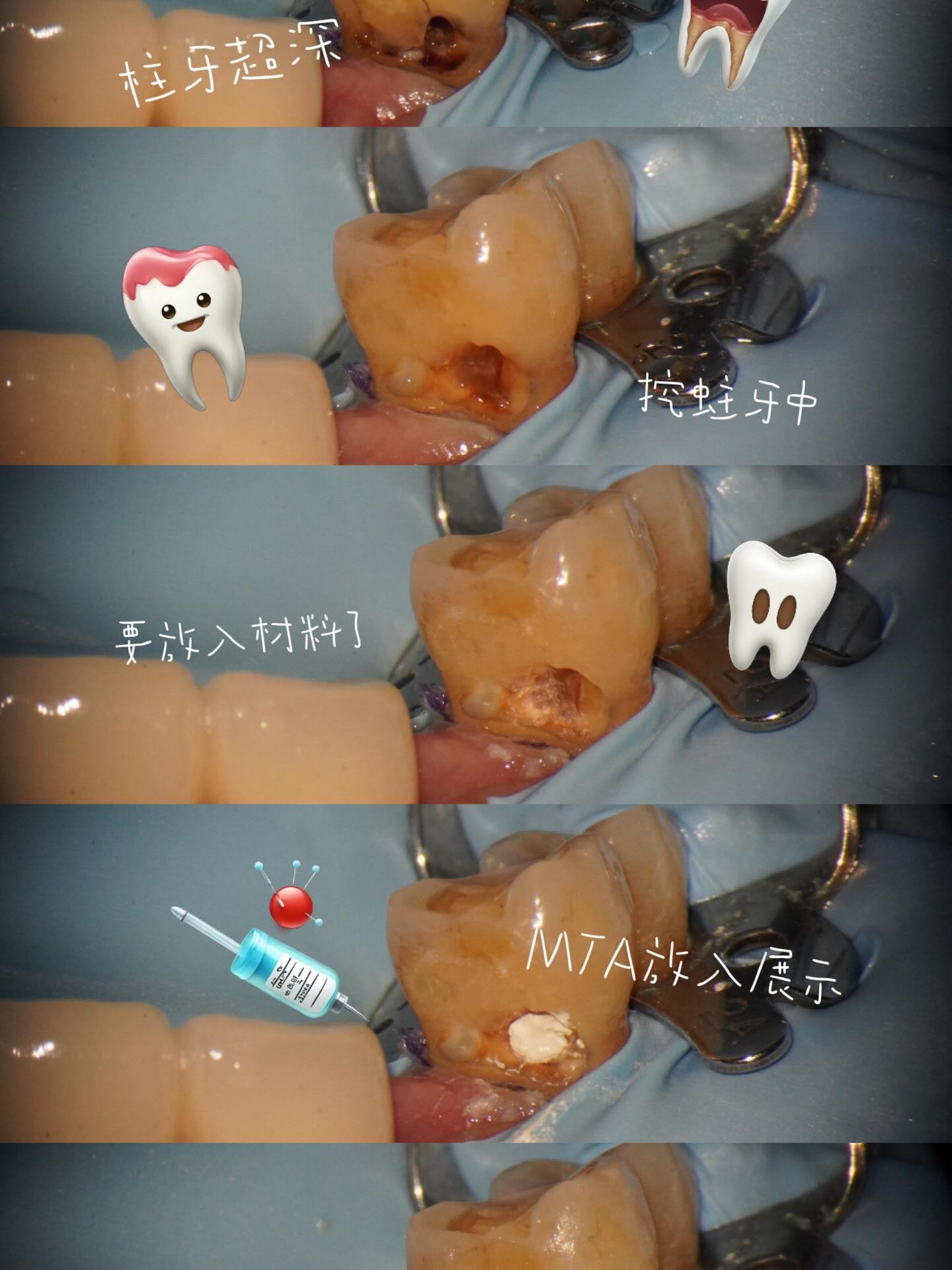 根管治療案例