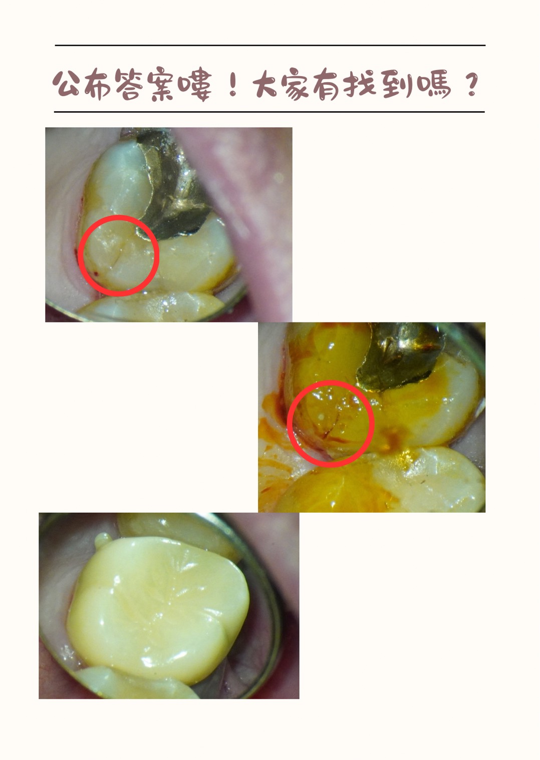 根管治療案例