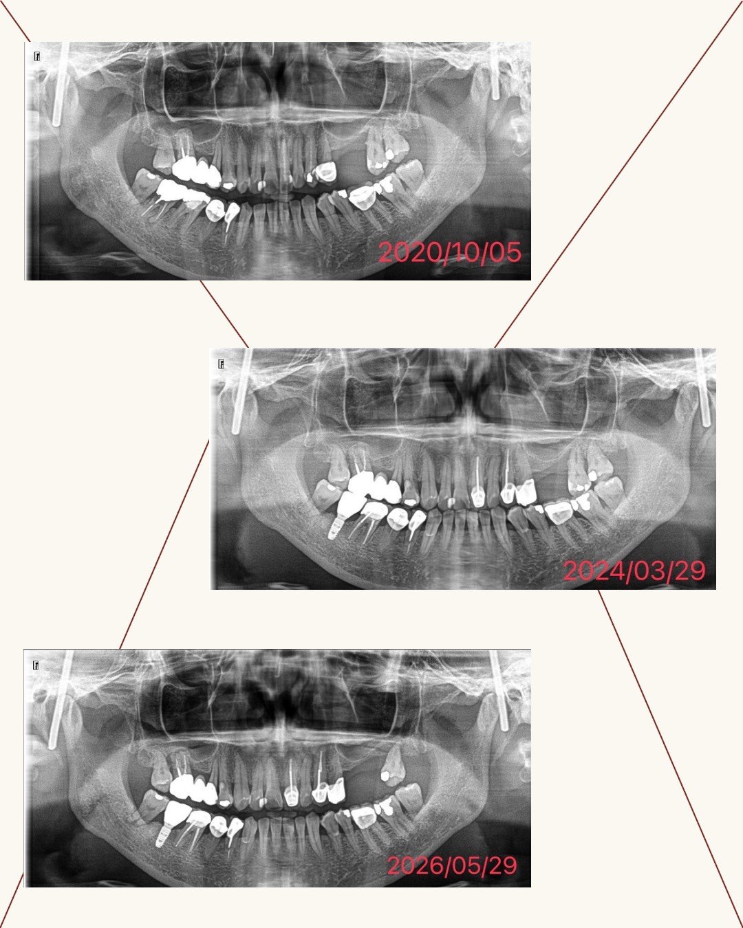 implant-denture-xray-timeline