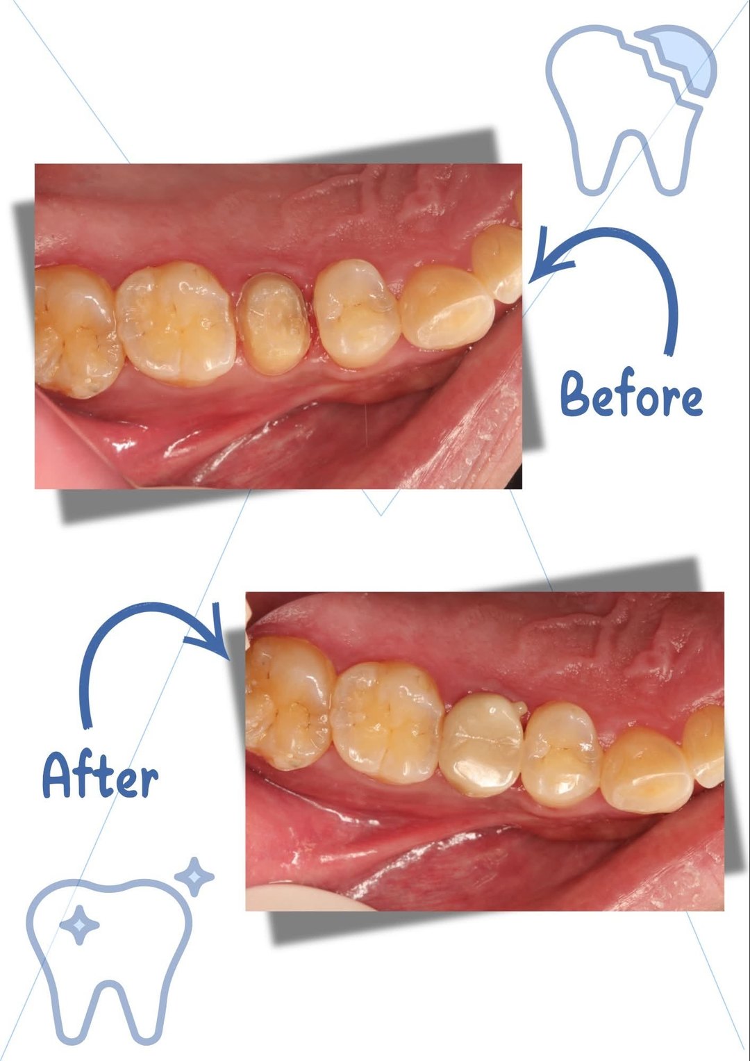 tooth-crack-zirconia-crown