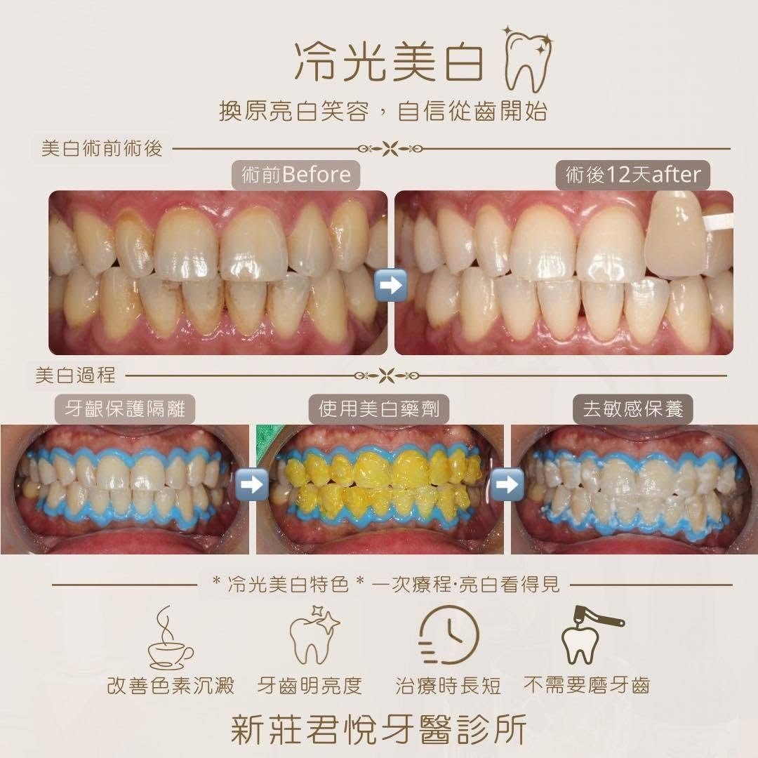 冷光美白治療前後對比