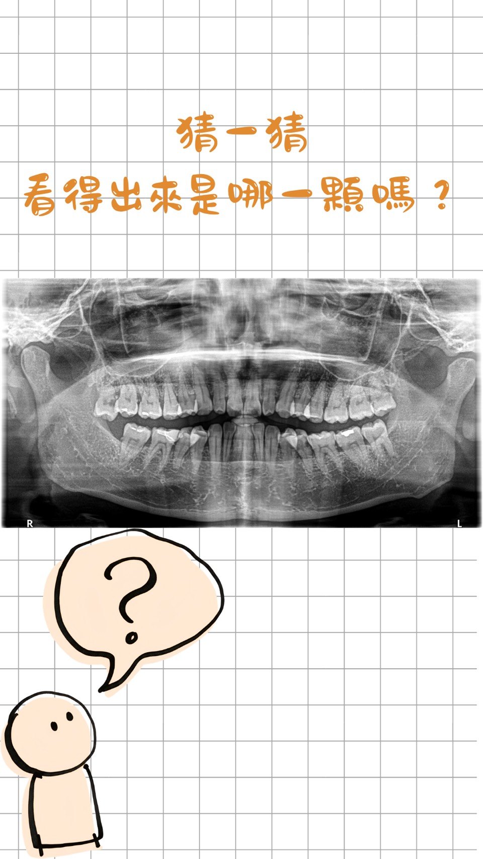智齒牙根彎曲 X 光片