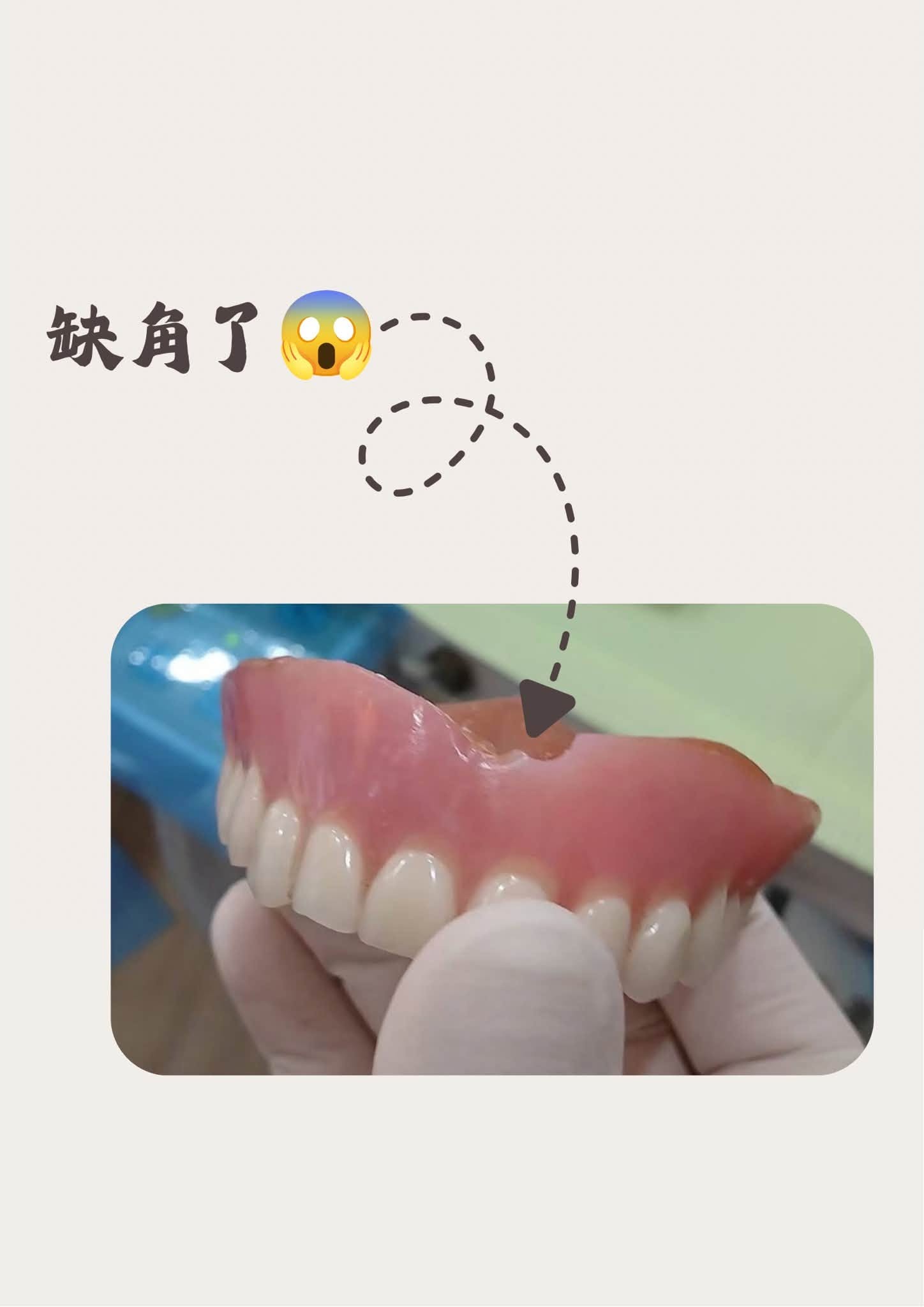 你知道活動假牙也會受傷嗎?