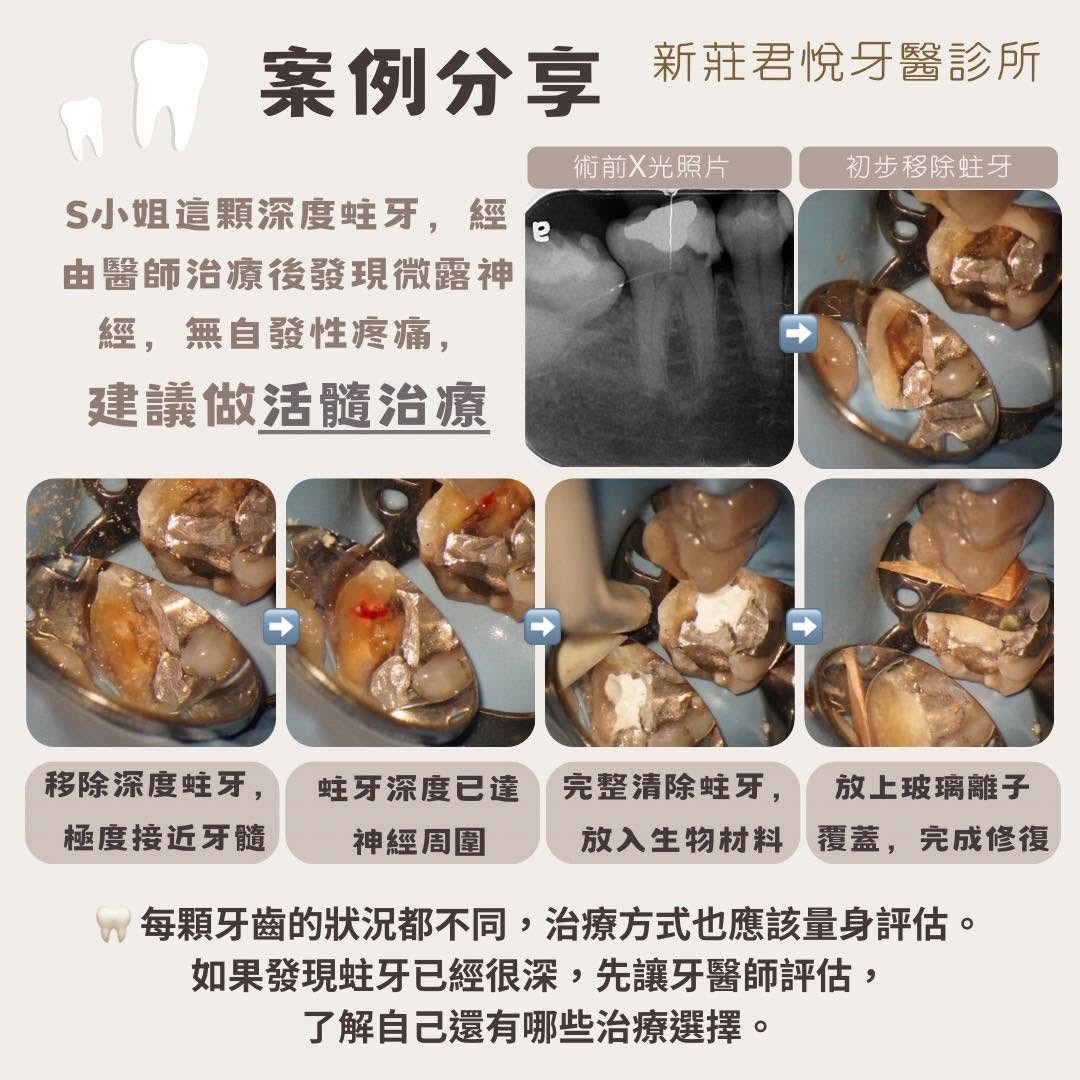 蛀牙了，就一定要做根管治療嗎？