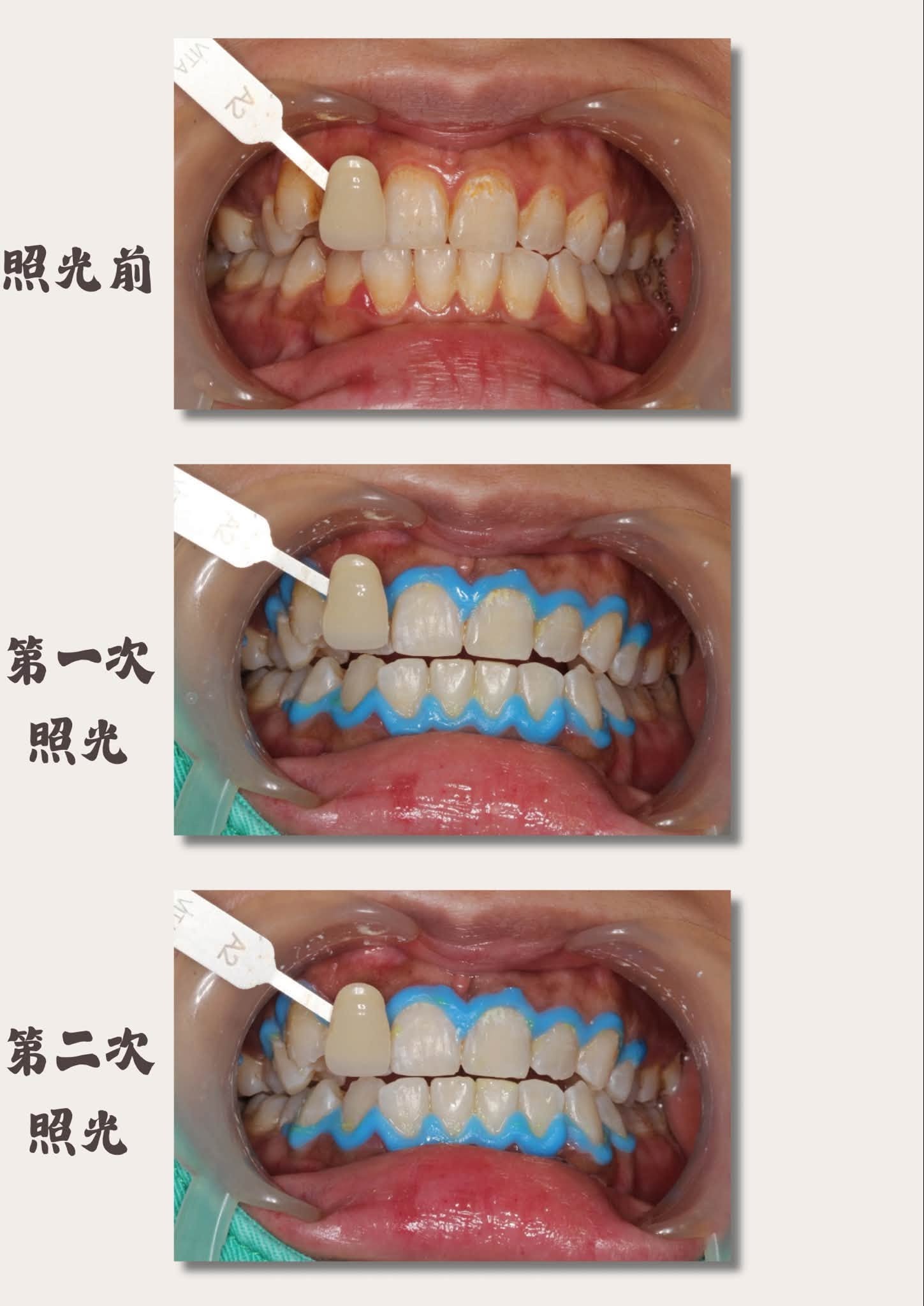 冷光美白過程:照光前、第一次照光、第二次照光