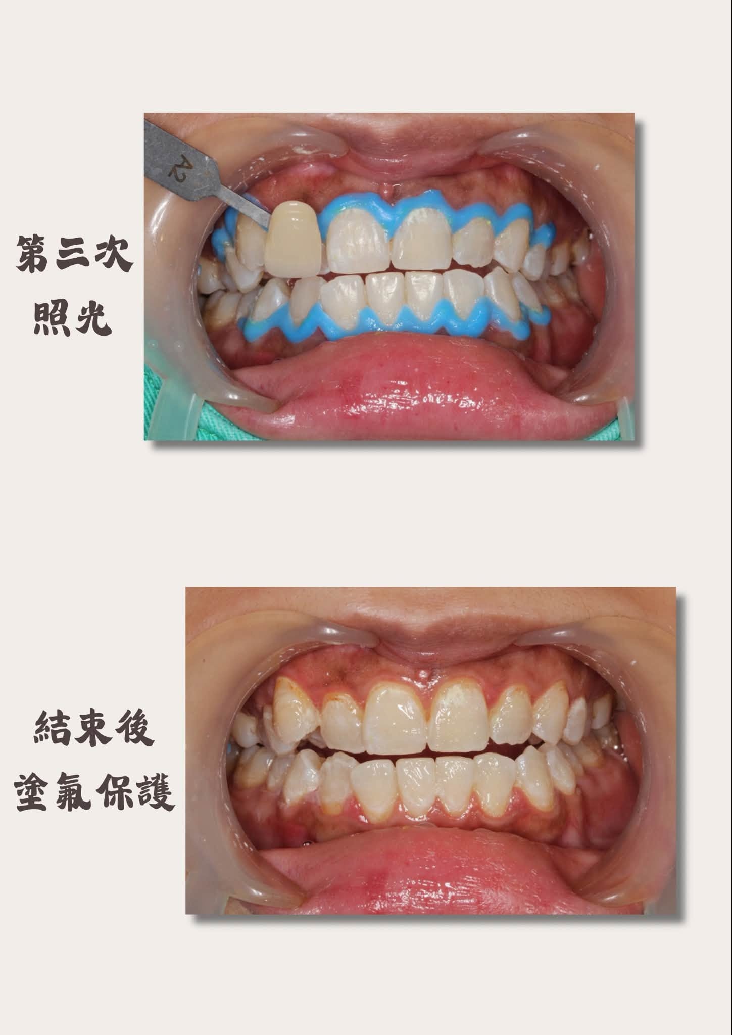 冷光美白過程:第三次照光、結束後塗氟保護