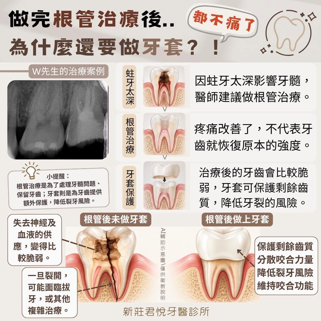 做完根管治療後為什麼還要做牙套？衛教圖